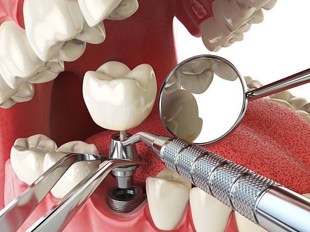Best Broken or Cracked Tooth Emergency Dentist in Inwood, FL